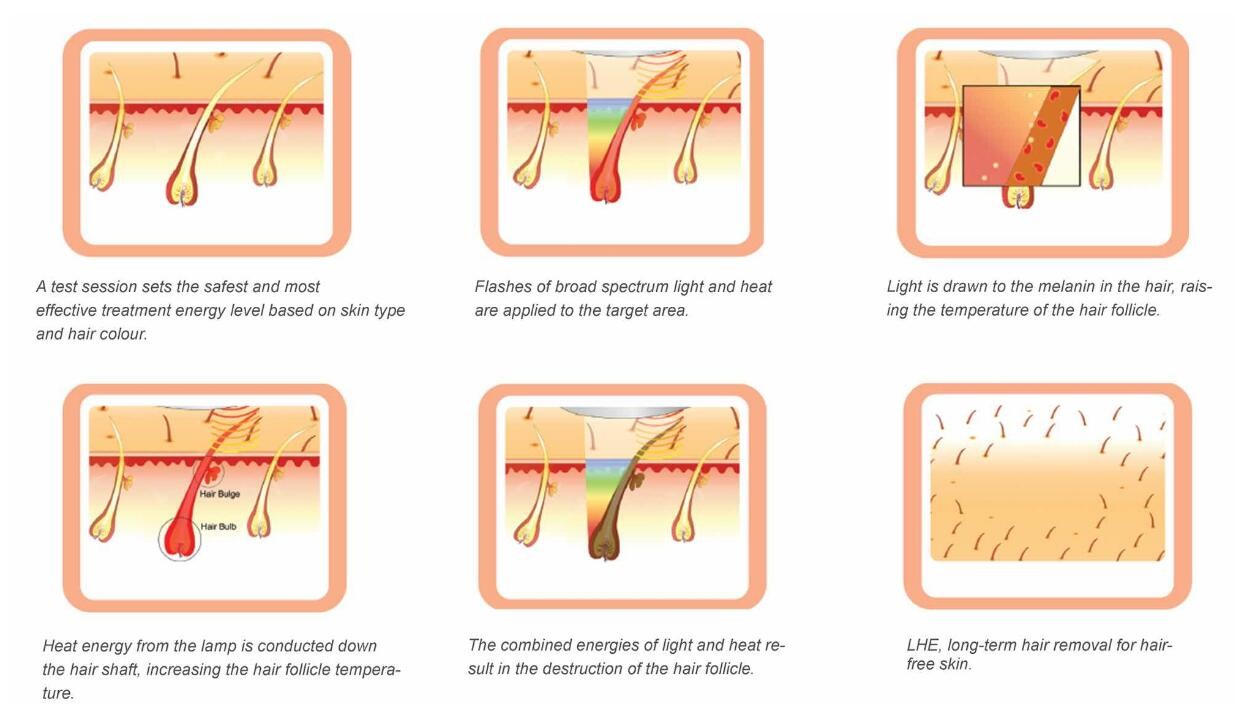 Multifunctional Nd Yag Laser Hair Depilation Machine IPL E Light High Efficiency