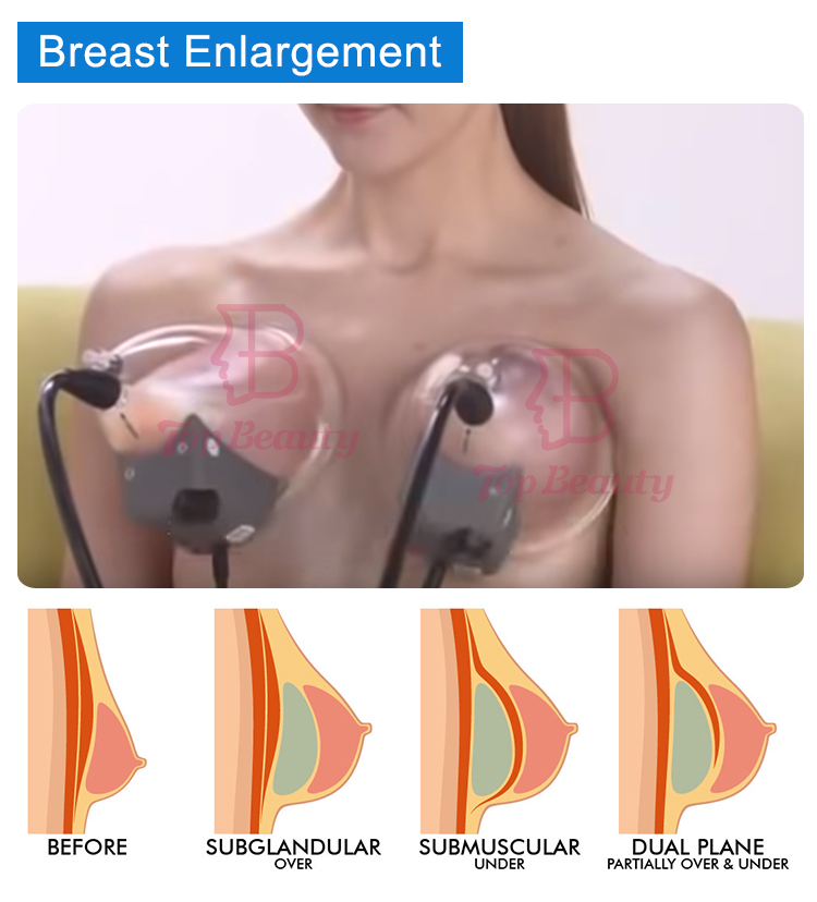 Portable Vacuum Breast Enlargement Machine For Body Shaping Vacuum Butt Enhancement Equipment
