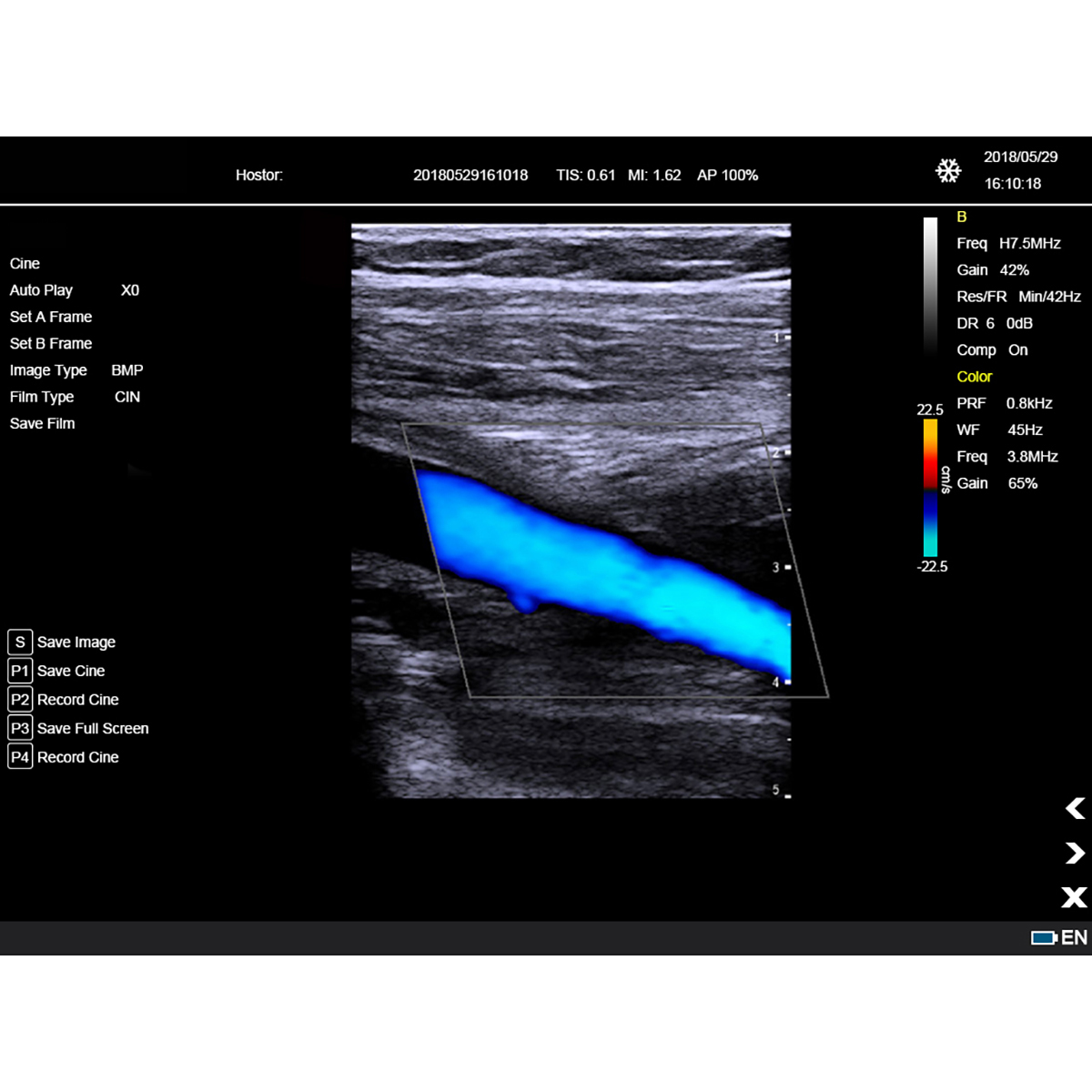 Color Doppler Portable Ultrasound Machine Medical USG PW CW DICOM Cardiac Probe Cardiology for Hospital Clinic