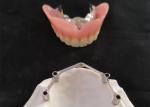 COCR Tooth Implant Crown FDA Dental Implants With Titanium Bar