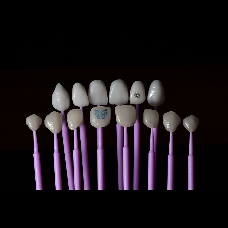Seamless Porcelain Emax Veneers Teeth Replacement Authentic Looking