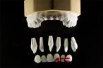 Feldspathic Porcelain Laminate Dental Veneer Seamless Customized