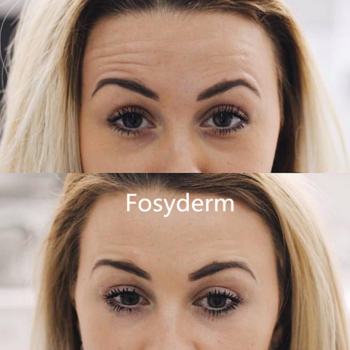 1ml Deep Wrinkles Hyaluronic Acid Injection Dermal Filler Cross Linked