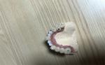 Accurate Biocompatibility Dental Implant Attachments Tooth Implant Crown