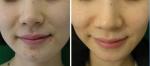 radio frequency microneedle rf skin tightening beauty machine