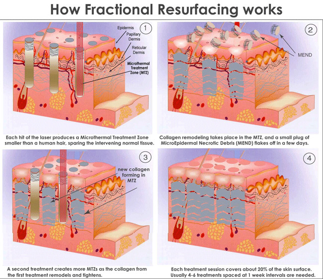 CO2 Fractional Laser Scar Removal Machine For Skin Repair Clinics With High Power Energy Output And Cooling System
