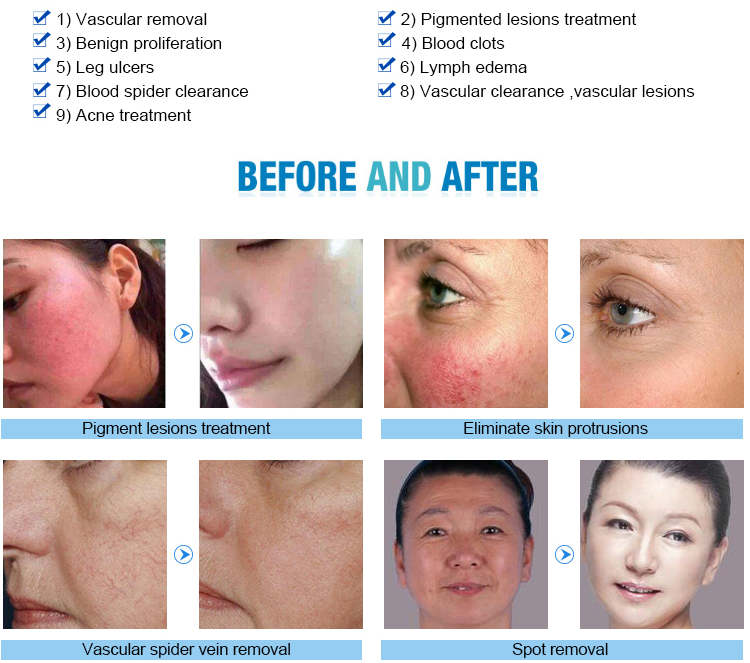 980nm Facial Thread Vein Removal Machine Diode Laser Vascular Therapy Device
