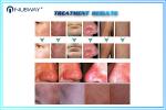 Beauty salon Equipment electrolysis machines for spider vein removal machine