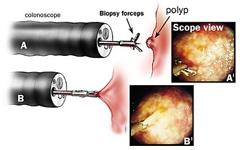 disposable biopsy forceps for lung biopsy complications