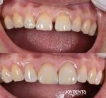 0.5mm Thickness Dental Veneers Perfect Permeability Porcelain Veneers For Gap
