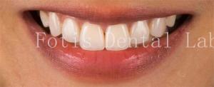Quality High End Cosmetic Teeth Veneers For Perfect Smile Stain Resistance wholesale