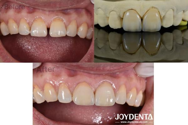 0.5mm Thickness Dental Veneers Perfect Permeability Porcelain Veneers For Gap