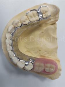 Quality Replace Missing Teeth Removable Partial Denture Dental Prosthesis Flexible Design wholesale