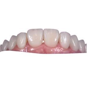 Quality 0.3MM Whitening Ceramic Dental Crown To Replace Unhealthy Teeth wholesale