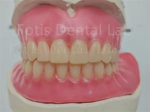Quality Affordable Custom Full Acrylic Denture With Ivoclar Teeth Easy To Use wholesale