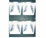 20cm x 25cm Medical Diagnostic Imaging , Laser Printer Film X Ray Paper