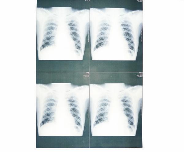 20cm x 25cm Medical Diagnostic Imaging , Laser Printer Film X Ray Paper