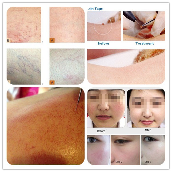 Effective Portable spider vein treatment Vascular removal beauty equipment