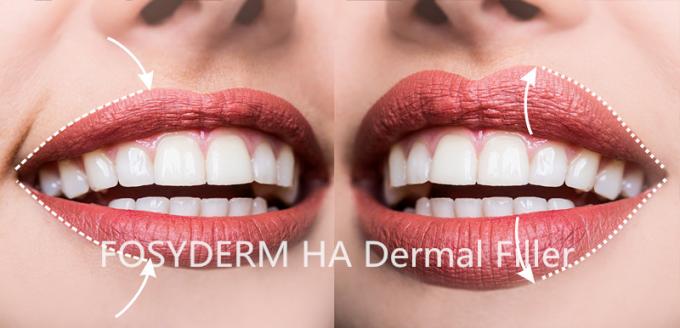 Odm Oem Hyaluronic Acid Facial Filler Gel Injection 6 - 18 Months Duration