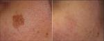 6mm YAG Bar Q Switch Laser Machine Tattoo Removal 1064nm 532nm 1320nm