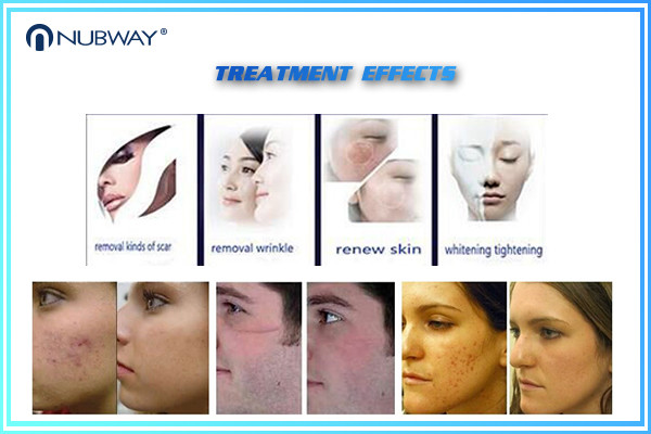 Hot sale scar removal skin tighten Fractional Laser Co2 / CO2 fractional laser/ fractional co2 laser machine
