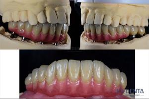 Quality Dental Reconstruction Multiple Teeth Implant Titanium Prosthetic Connection Internal wholesale