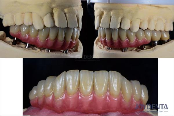 Dental Reconstruction Multiple Teeth Implant Titanium Prosthetic Connection