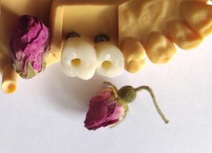 Quality Cemented Implants Crowns Bridges wholesale
