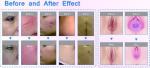 Stationary Fractional Laser Co2 Machine Scar Removal Infrared Skin