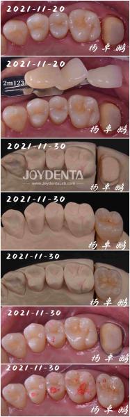 Seamless Fit Porcelain Inlay Dental Procedure Customizable Shape For Teeth
