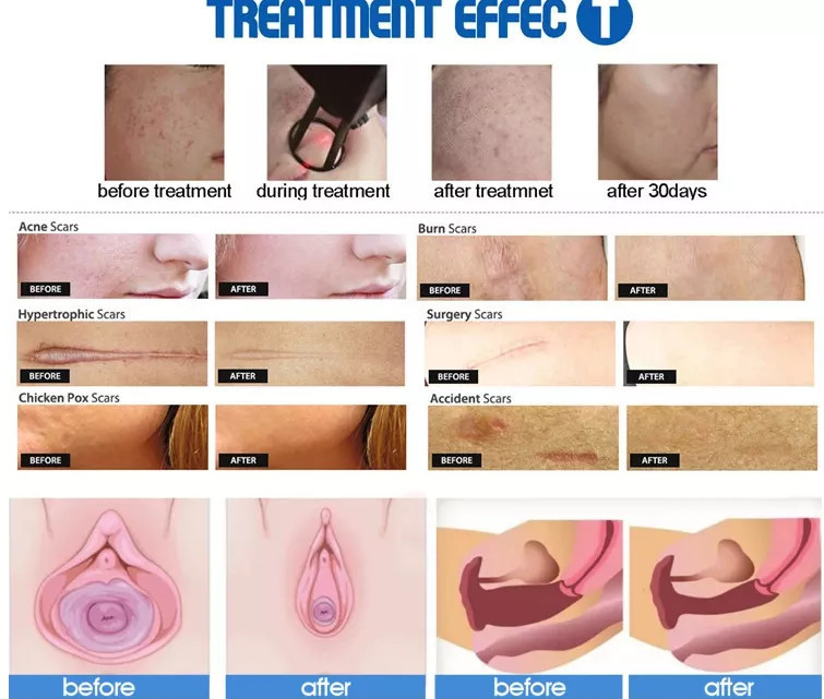 Fractional Co2 Laser Skin Renew Beauty Equipment Stretch Marks Removal Machine