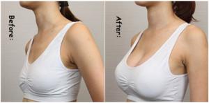Quality Hyaluronic Acid Breast Injection Filler Breast Sodium Hyaluronate Enhancement Gel wholesale