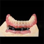 CAM Milled Titanium Bar Dental Implant Hybrid Prosthesis Dentures