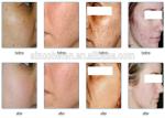 Professional IPL Skin Rejuvenation Machine , Intense Pulsed Light Hair Removal