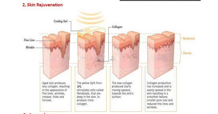 portable IPL hair removal machine/ IPL machine/ portable IPL