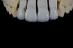 Handcrafted Porcelain Feldspathic Dental Veneer Natural Looking