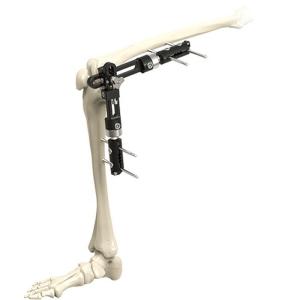 Quality High Quality Orthopedic Surgical Instruments Knee Joint External Fixator External Fixation Orthopedic Surgical Instrumen wholesale