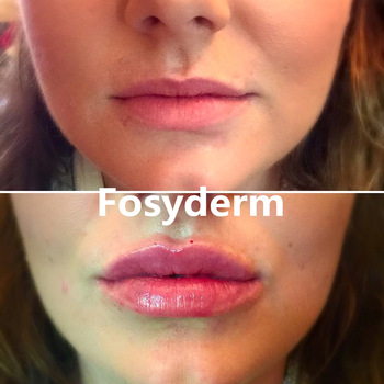 Transparent 1ml Sexy Lips Hyaluronic Acid Derm Line Gel Dermal Lip Fillers