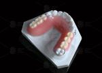 Orange Pink Acrylic Partial Denture Natural Looking 3d Printing Digital Dentures