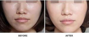 Quality Non Cross Linked Sodium Hyaluronate Rejuvenating Injection For Skin Care wholesale