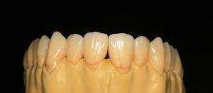 Quality Dental Lab Fixed Prosthetics Layered Zirconia Dental Crown For Front Teeth wholesale