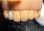 Chromecast Safety PFM Dental Crown Bridge Good Biocompatibility
