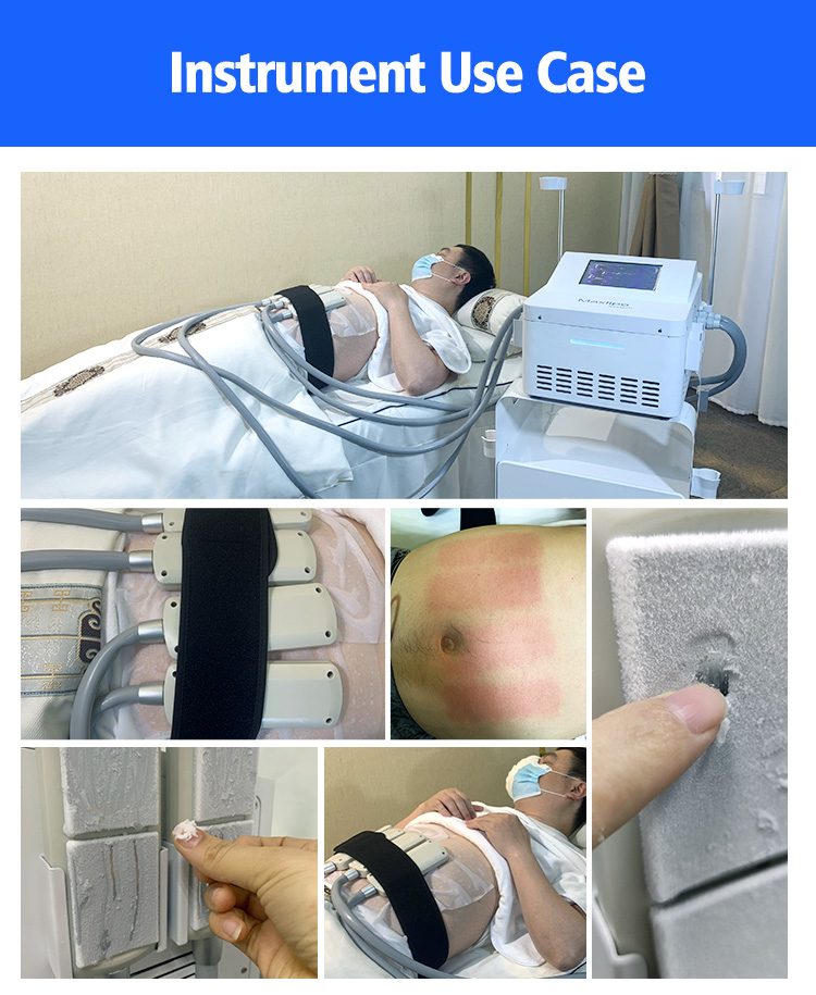 Body Contouring Cellulite Reduction Machine 3.5L Water Tank For Home Use