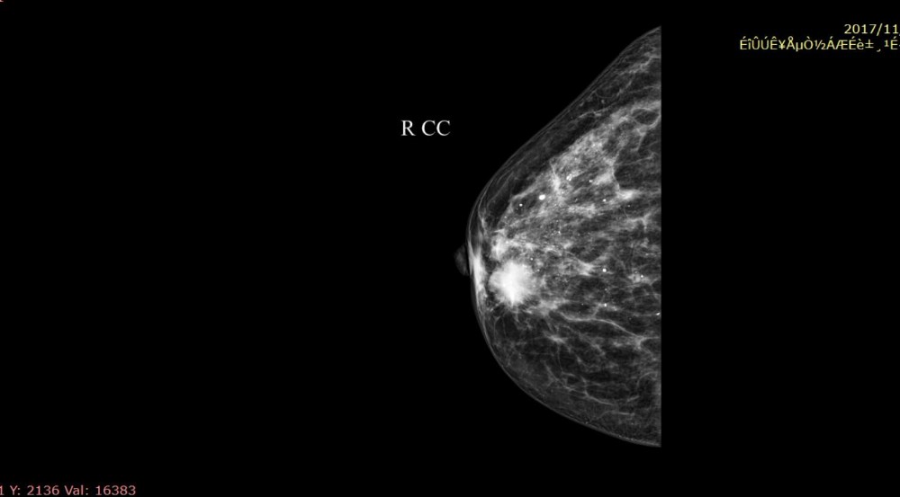 Full Digital Mammography System with Panel Detector for Sales
