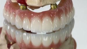 Quality Dental All On X Implant PFM Crown Titanium Fixed Hybrid Denture wholesale