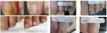 Home Use Laser Tattoo Removal Machine Therapy Device Fungal Remover Onychomycosi