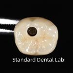 Screw Retained Dental Implant Crown