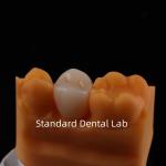 Full Contour Zirconia Crown Exceptional Strength and Esthetics No Porcelian
