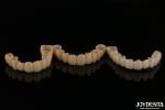 Natural Looking Porcelain Layered Zirconia Bridges Wear Resistance High