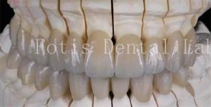 Quality Natural-Looking Smile Prosthetic Porcelain Laminate Veneers Smooth Surface wholesale